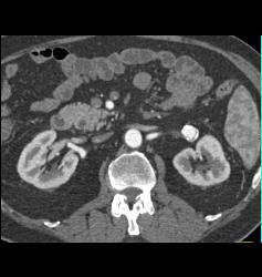 Left Renal Artery Aneurysm - CTisus CT Scan