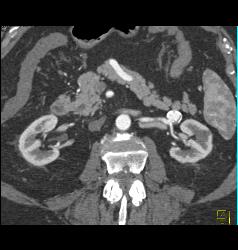 Left Renal Artery Aneurysm - CTisus CT Scan