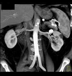 Left Renal Artery Aneurysm - CTisus CT Scan