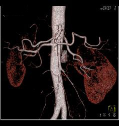 Subtle Fibromuscular Dysplasia (FMD) Right Renal Artery - CTisus CT Scan