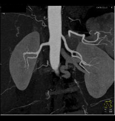 Subtle Fibromuscular Dysplasia (FMD) Right Renal Artery - CTisus CT Scan