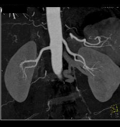 Subtle Fibromuscular Dysplasia (FMD) Right Renal Artery - CTisus CT Scan