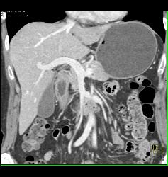 Subtle Fibromuscular Dysplasia (FMD) Right Renal Artery - CTisus CT Scan