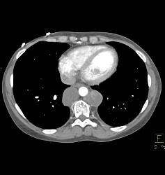 Recurrent Renal Cell Carcinoma With Extensive Adenopathy Which Is Cystic and Necrotic - CTisus CT Scan