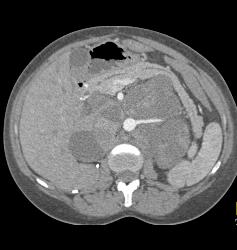 Recurrent Renal Cell Carcinoma With Extensive Adenopathy Which Is Cystic and Necrotic - CTisus CT Scan