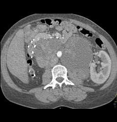 Recurrent Renal Cell Carcinoma With Extensive Adenopathy Which Is Cystic and Necrotic - CTisus CT Scan