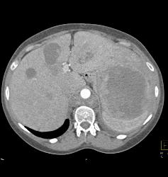 Recurrent Renal Cell Carcinoma With Extensive Adenopathy Which Is Cystic and Necrotic - CTisus CT Scan