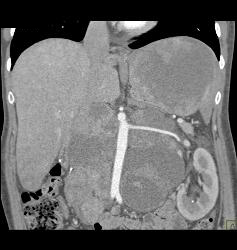 Recurrent Renal Cell Carcinoma With Extensive Adenopathy Which Is Cystic and Necrotic - CTisus CT Scan