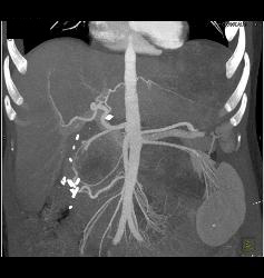 Recurrent Renal Cell Carcinoma With Extensive Adenopathy Which Is Cystic and Necrotic - CTisus CT Scan