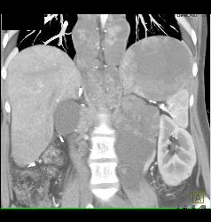 Recurrent Renal Cell Carcinoma With Extensive Adenopathy Which Is Cystic and Necrotic - CTisus CT Scan