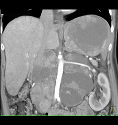 Recurrent Renal Cell Carcinoma With Extensive Adenopathy Which Is Cystic and Necrotic - CTisus CT Scan