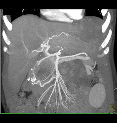 Recurrent Renal Cell Carcinoma With Extensive Adenopathy Which Is Cystic and Necrotic - CTisus CT Scan