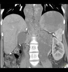 Recurrent Renal Cell Carcinoma With Extensive Adenopathy Which Is Cystic and Necrotic - CTisus CT Scan