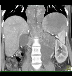 Recurrent Renal Cell Carcinoma With Extensive Adenopathy Which Is Cystic and Necrotic - CTisus CT Scan