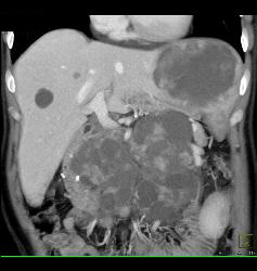 Recurrent Renal Cell Carcinoma With Extensive Adenopathy Which Is Cystic and Necrotic - CTisus CT Scan