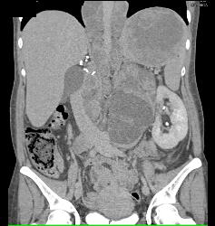 Recurrent Renal Cell Carcinoma With Extensive Adenopathy Which Is Cystic and Necrotic - CTisus CT Scan