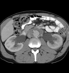 Retroperitoneal Fibrosis - CTisus CT Scan