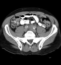 Retroperitoneal Fibrosis - CTisus CT Scan