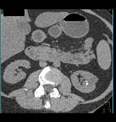 Left Renal Cyst - CTisus CT Scan