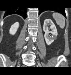 Left Renal Cyst - CTisus CT Scan