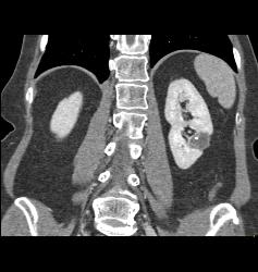 Left Renal Cyst - CTisus CT Scan