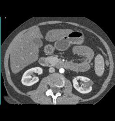 Left Renal Cyst - CTisus CT Scan