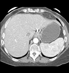 Recurrent Renal Cell Carcinoma in Right Renal Bed With IVC Extension - CTisus CT Scan