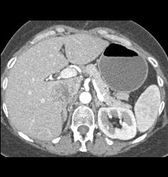 Recurrent Renal Cell Carcinoma in Right Renal Bed With IVC Extension - CTisus CT Scan