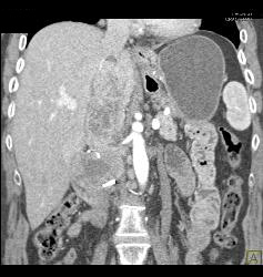 Recurrent Renal Cell Carcinoma in Right Renal Bed With IVC Extension - CTisus CT Scan