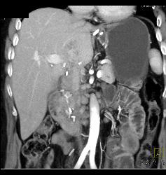 Recurrent Renal Cell Carcinoma in Right Renal Bed With IVC Extension - CTisus CT Scan