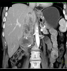 Recurrent Renal Cell Carcinoma in Right Renal Bed With IVC Extension - CTisus CT Scan