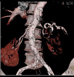 Renal Artery Stenosis - CTisus CT Scan