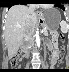 Recurrent Renal Cell Carcinoma in Right Renal Bed With IVC Extension - CTisus CT Scan