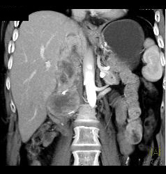 Recurrent Renal Cell Carcinoma in Right Renal Bed With IVC Extension - CTisus CT Scan