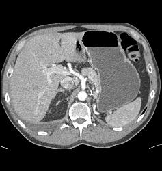 Recurrent Renal Cell Carcinoma With Contralateral Adenopathy - CTisus CT Scan