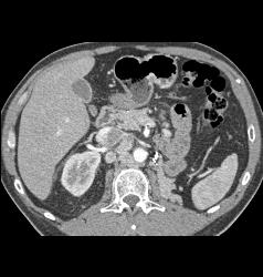 Recurrent Renal Cell Carcinoma With Contralateral Adenopathy - CTisus CT Scan