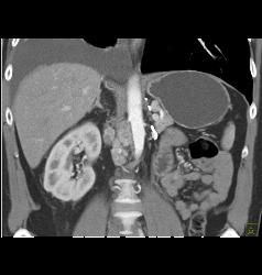 Recurrent Renal Cell Carcinoma With Contralateral Adenopathy - CTisus CT Scan