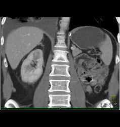 Contralateral Renal Metastases Vs Second Primary Renal - CTisus CT Scan