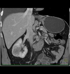 Contralateral Renal Metastases Vs Second Primary Renal - CTisus CT Scan