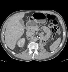 Contralateral Renal Metastases Vs Second Primary Renal - CTisus CT Scan