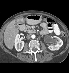 Left Hydronephrosis Due to Tumor Recurrence Near Anastomosis - CTisus CT Scan