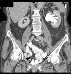 Left Hydronephrosis Due to Tumor Recurrence Near Anastomosis - CTisus CT Scan