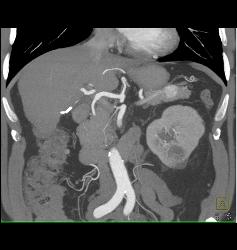Recurrent Renal Cell Carcinoma With Metastases to the Pancreas - CTisus CT Scan