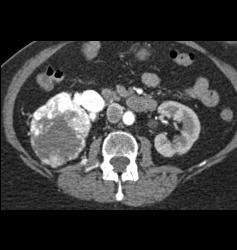 Renal Cell Carcinoma Involves the Adrenal Gland- Hypervascular - CTisus CT Scan