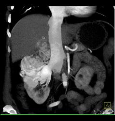 Renal Cell Carcinoma Involves the Adrenal Gland- Hypervascular - CTisus CT Scan