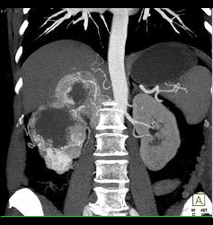 Renal Cell Carcinoma Involves the Adrenal Gland- Hypervascular - CTisus CT Scan