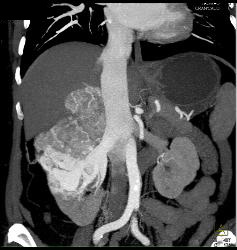 kidney adrenal gland tumor