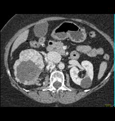 Renal Cell Carcinoma Involves the Adrenal Gland- Hypervascular - CTisus CT Scan