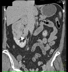 Renal Cell Carcinoma Involves the Adrenal Gland- Hypervascular - CTisus CT Scan