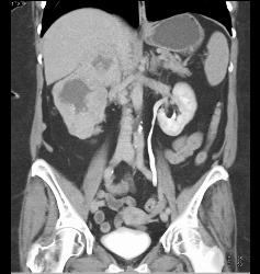 Renal Cell Carcinoma Involves the Adrenal Gland- Hypervascular - CTisus CT Scan